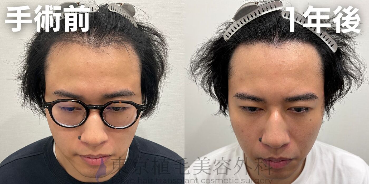 画像4359：✅20代男性 ✅眉毛植毛100株  ✅2024年8月手術 ✅術後6ヶ月