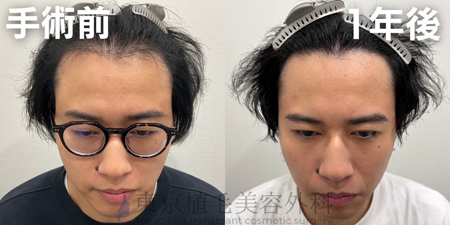 画像4359：✅20代男性 ✅眉毛植毛100株  ✅2024年8月手術 ✅術後6ヶ月