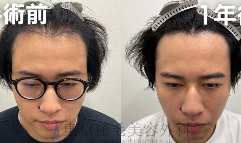 画像4361：当院で2500株の植毛手術をなさった30代男性患者様の術後1年の症例が公開されました