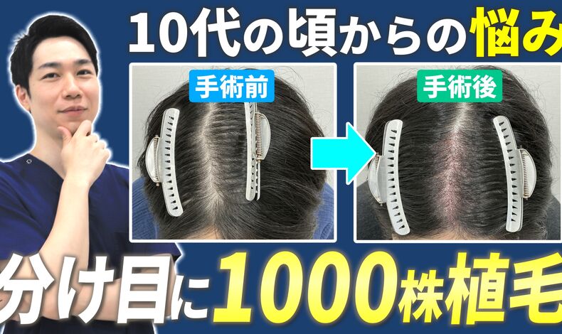 画像4363：東京植毛美容外科で前頭部・分け目に1000株の植毛手術をした20代男性のYouTubeが公開されました