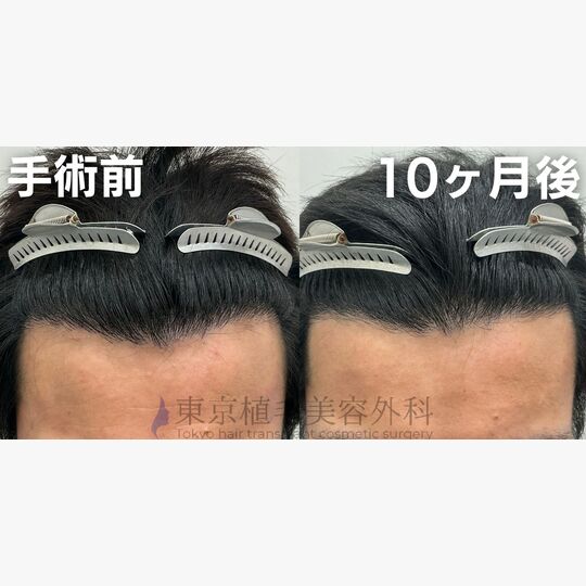 画像4369：✅30代 男性 ✅FUE1,000株 ✅生え際の手術 ✅手術10ヶ月後