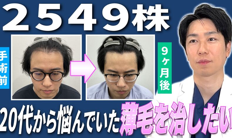 画像4371：東京植毛美容外科で2500株の植毛手術をなさった30代男性の経過9ヶ月がYouTubeに公開されました
