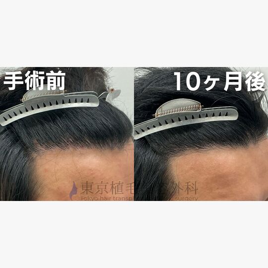 画像4403：✅30代 男性 ✅FUE1,000株 ✅生え際の手術 ✅手術10ヶ月後