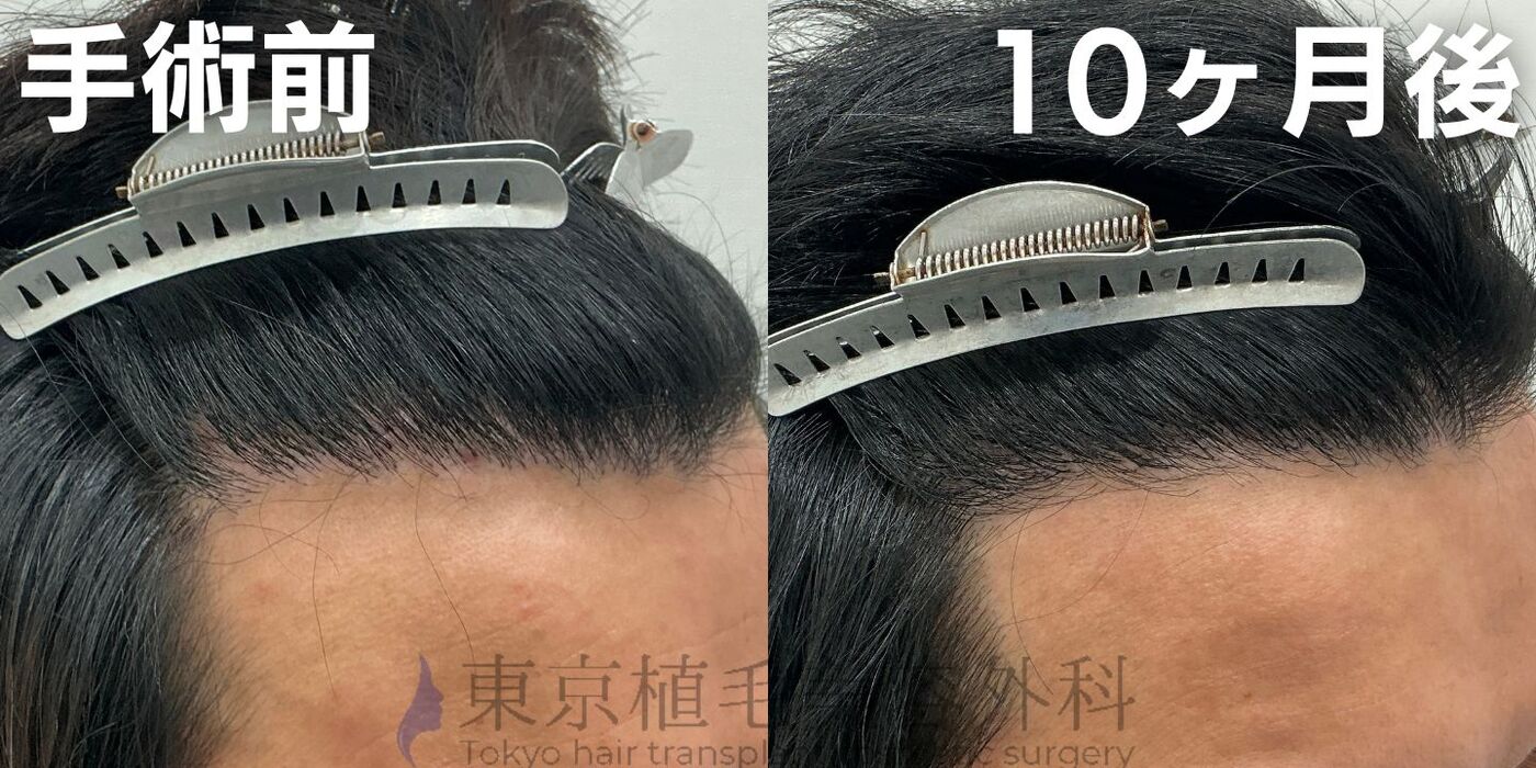 画像4403：✅20代男性 ✅眉毛植毛100株  ✅2024年8月手術 ✅術後6ヶ月