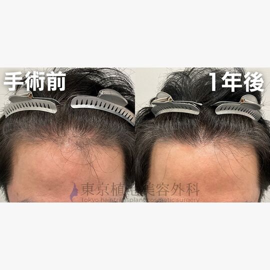 画像4404：✅40代 男性 ✅FUE1,500株 ✅前頭部・生え際・こめかみの症例 ✅手術１年後