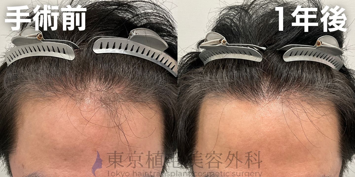画像4404：✅20代男性 ✅眉毛植毛100株  ✅2024年8月手術 ✅術後6ヶ月