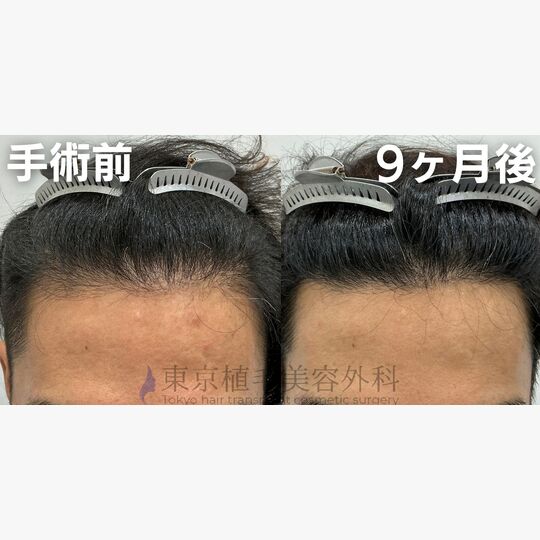 画像4408：✅40代 男性 ✅FUE1,500株 ✅生え際・前頭部の手術 ✅手術9ヶ月後