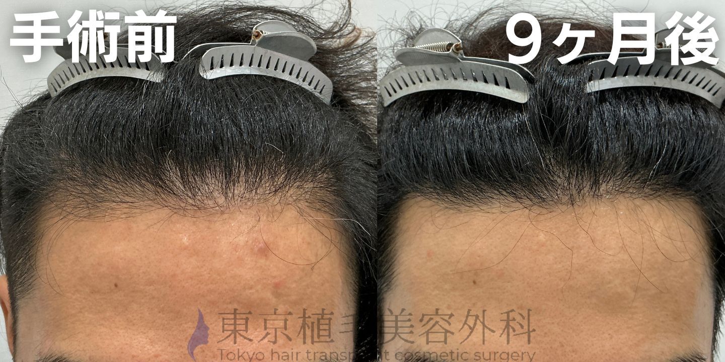画像4408：✅20代男性 ✅眉毛植毛100株  ✅2024年8月手術 ✅術後6ヶ月