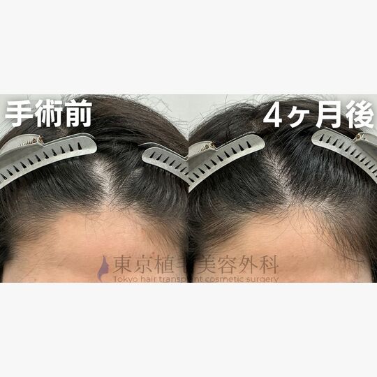 画像4411：✅20代 男性 ✅FUE1,021株 ✅生え際の手術 ✅手術4ヶ月後