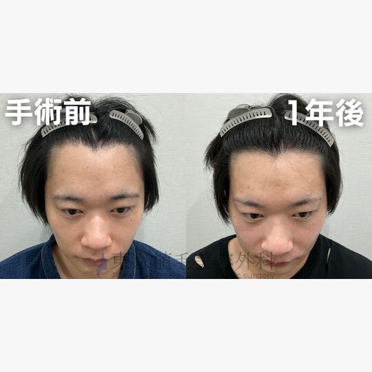 画像4415：✅30代 男性 ✅FUE1,300株 ✅生え際の手術 ✅手術1年後