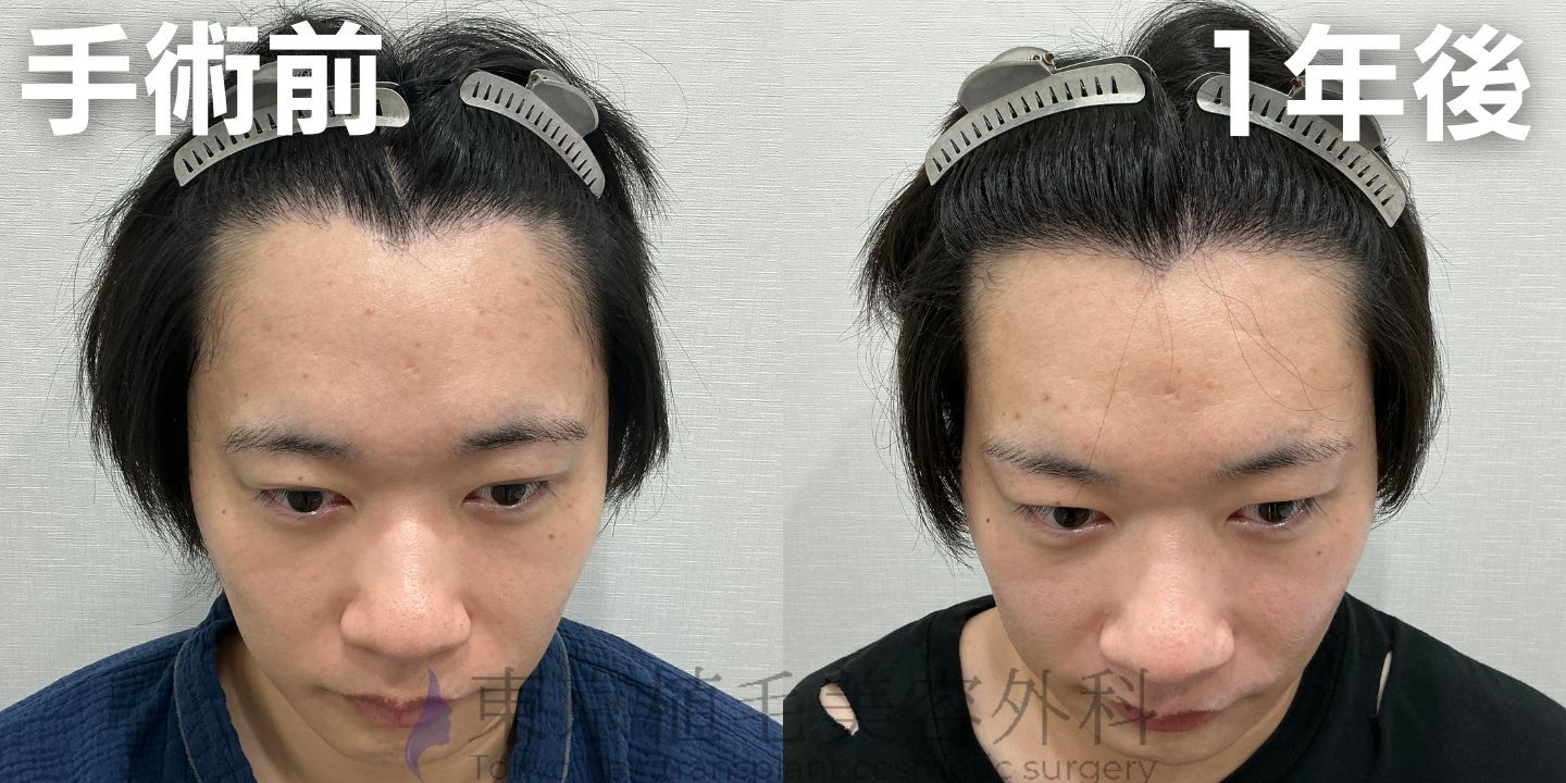 画像4415：✅20代男性 ✅眉毛植毛100株  ✅2024年8月手術 ✅術後6ヶ月