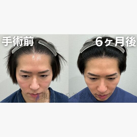 画像4416：✅40代 男性 ✅FUE2,528株 ✅生え際の手術 ✅手術6ヶ月後