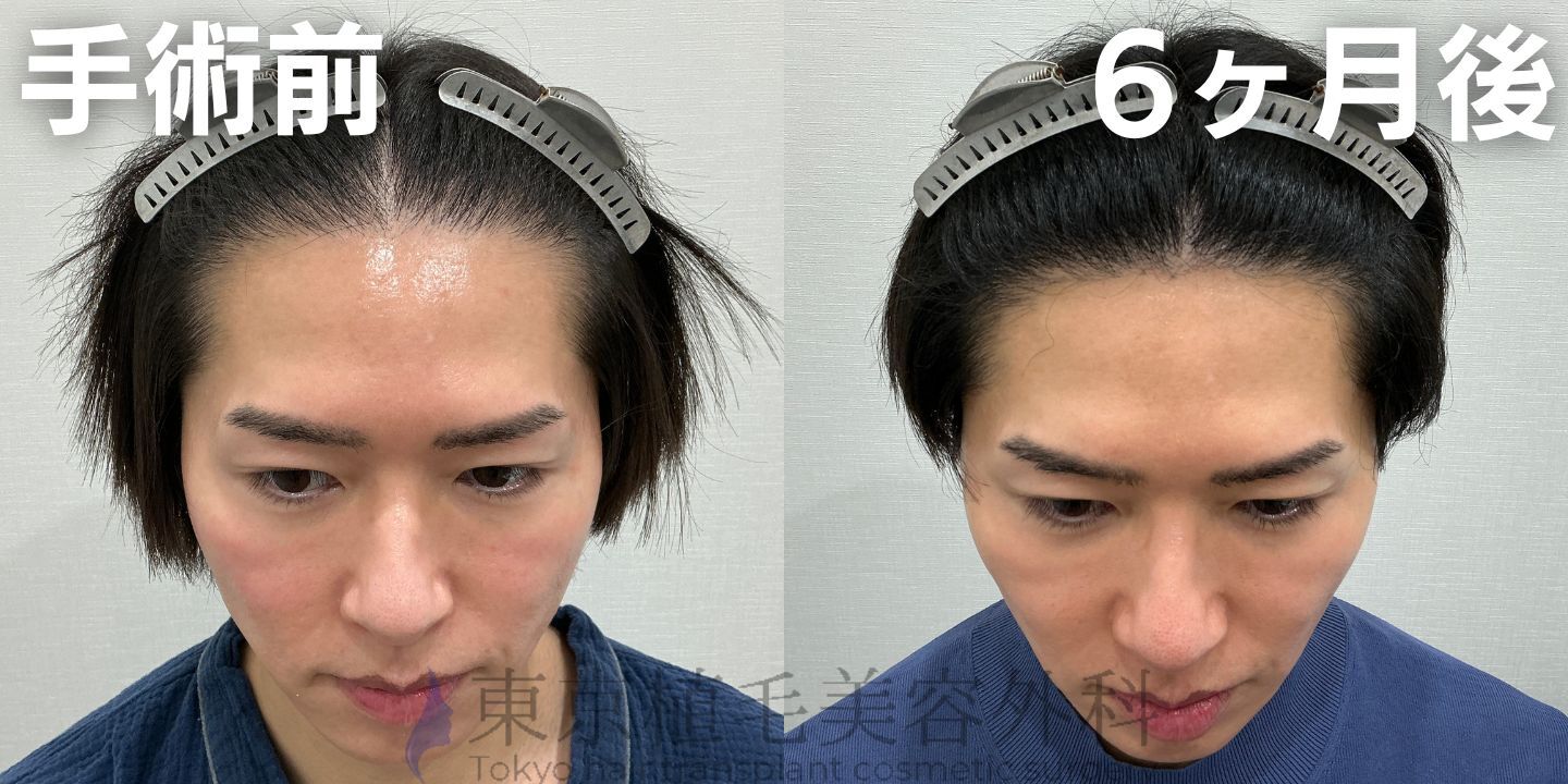 画像4416：✅20代男性 ✅眉毛植毛100株  ✅2024年8月手術 ✅術後6ヶ月