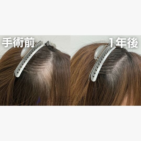 画像4425：✅20代 女性 ✅FUE650株 ✅M字の透けた部分の手術 ✅手術1年後