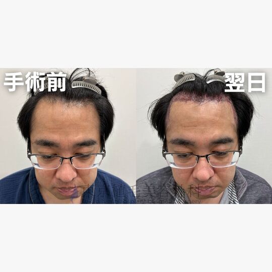 画像4427：✅40代 男性 ✅FUE1,892株 ✅生え際の手術 ✅手術翌日