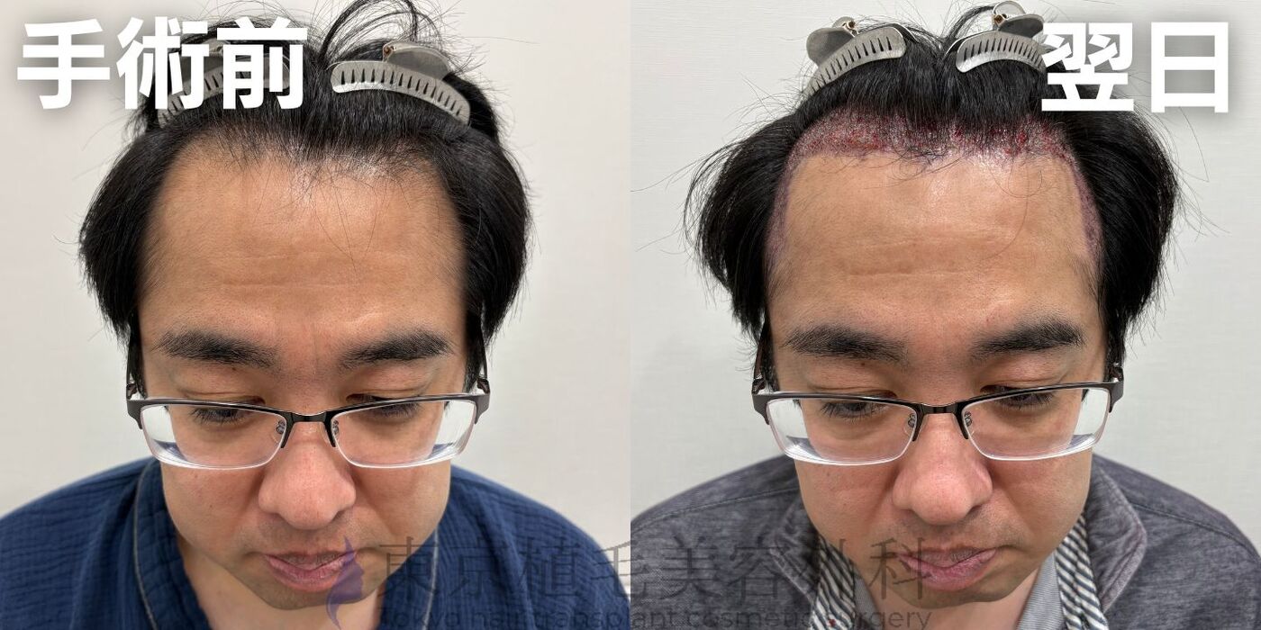 画像4427：✅20代男性 ✅眉毛植毛100株  ✅2024年8月手術 ✅術後6ヶ月