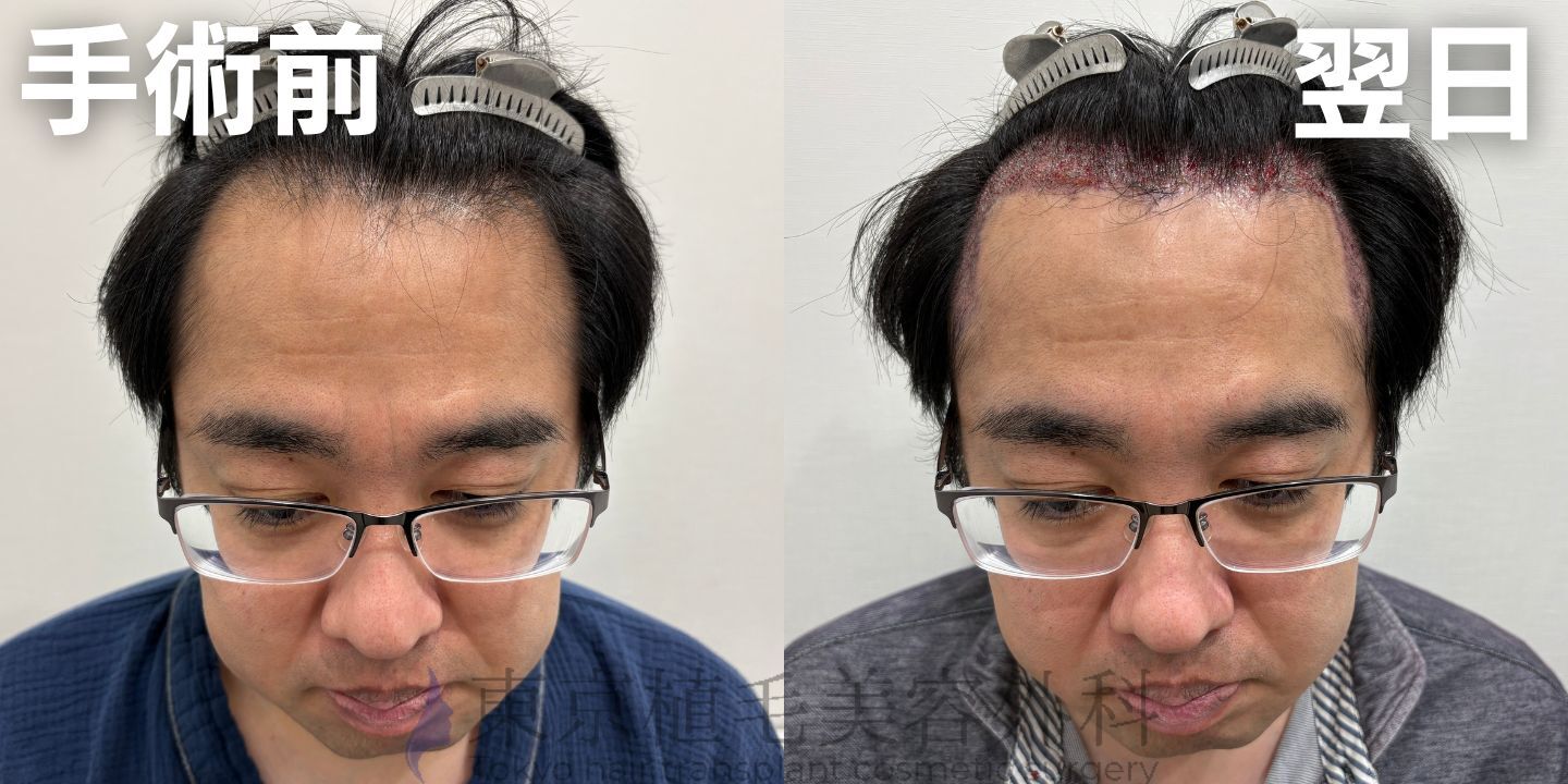 画像4427：✅20代男性 ✅眉毛植毛100株  ✅2024年8月手術 ✅術後6ヶ月