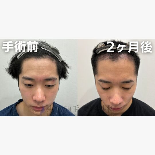 画像4434：✅20代 男性 ✅FUE1,979株 ✅生え際・前頭部の手術 ✅手術2ヶ月後