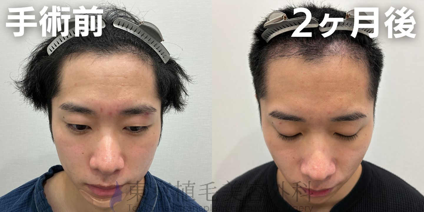 画像4434：✅20代男性 ✅眉毛植毛100株  ✅2024年8月手術 ✅術後6ヶ月