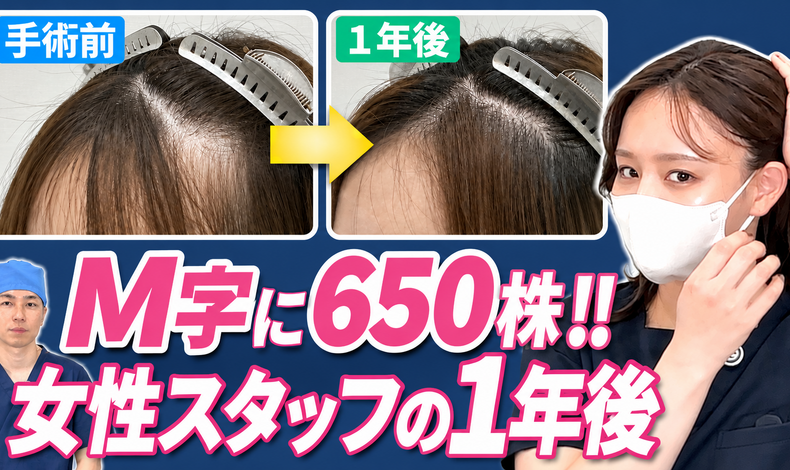 画像4436：東京植毛美容外科で650株の植毛手術を実施した女性患者様の1年経過がYouTubeに公開されました