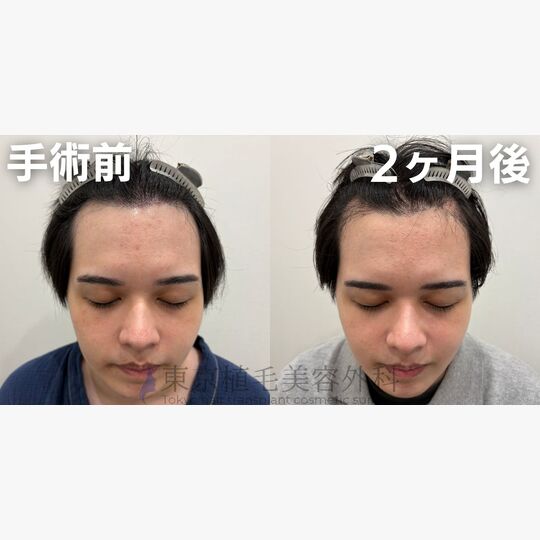 画像4488：✅20代 男性 ✅FUE2,208株 ✅生え際・前頭部・頭頂部の手術 ✅手術2ヶ月後
