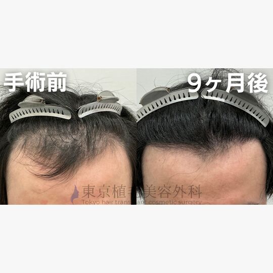 画像4489：✅20代 男性 ✅FUE2,615株 ✅生え際の手術 ✅9ヶ月後