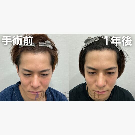 画像4490：✅30代 男性 ✅FUE1,900株 ✅生え際・頭頂部・こめかみの手術 ✅手術1年後